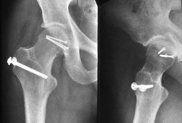 Femoral head fracture